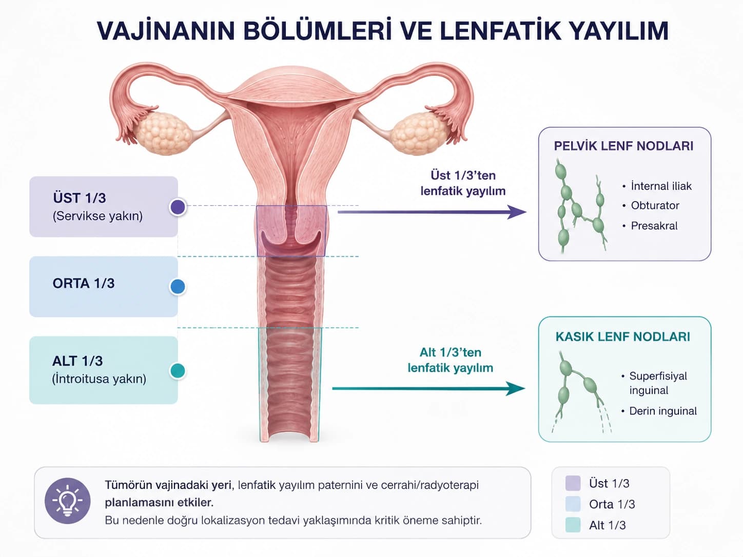 Vajinanın üst, orta ve alt üçte birlik bölümleri ile pelvik ve kasık lenf nodlarına olası lenfatik yayılım yollarını gösteren tıbbi infografik.
