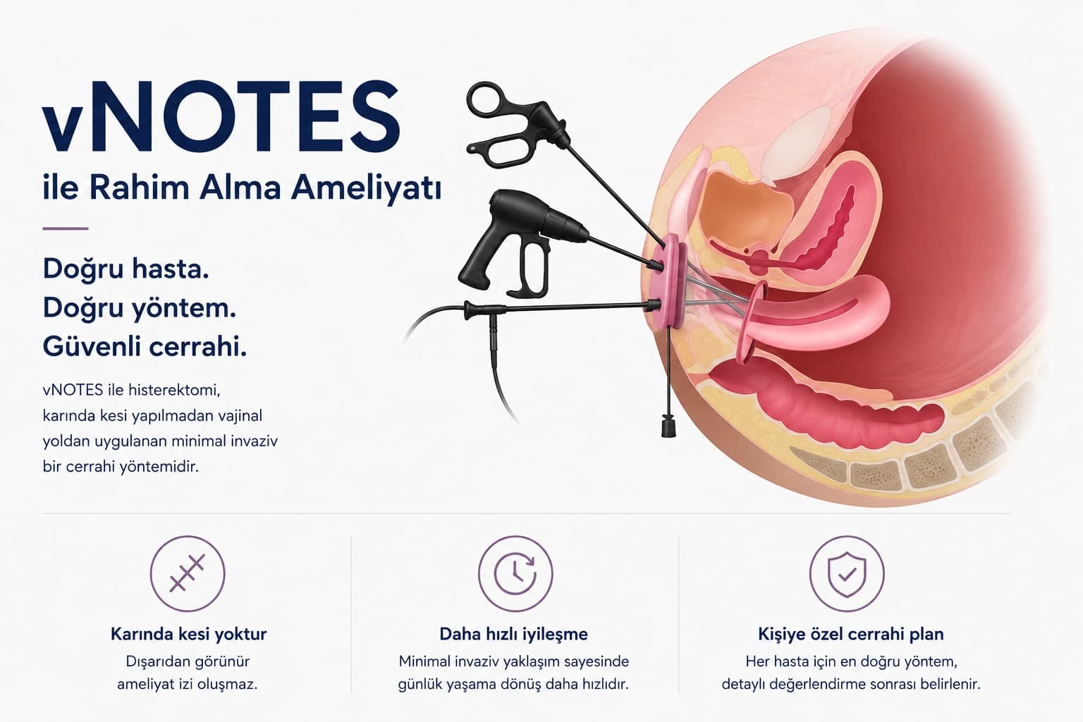 vNOTES ile rahim alma ameliyatının şematik gösterimi. Vajinal yoldan yerleştirilen kamera ve cerrahi enstrümanlarla gerçekleştirilen minimal invaziv histerektomi tekniği.