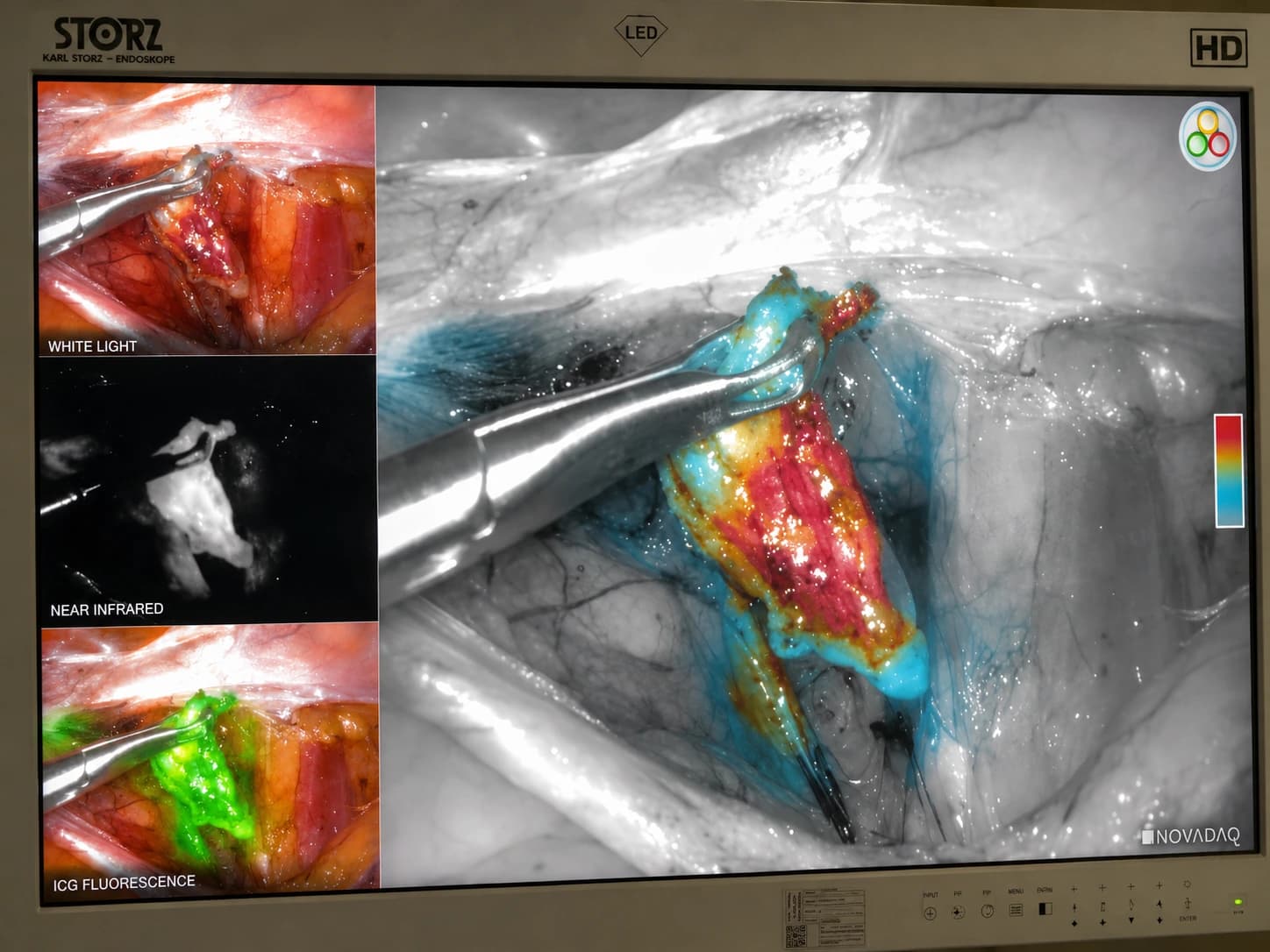 Endometrium kanseri cerrahisinde ICG floresans teknolojisi kullanılarak sentinel lenf nodu haritalamasını gösteren laparoskopik cerrahi monitör görüntüsü; beyaz ışık, near infrared ve floresans modlarının karşılaştırmalı görünümü.