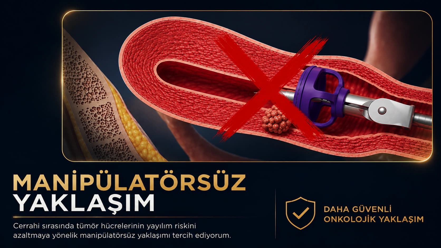 Serviks kanserinde manipülatörsüz cerrahi yaklaşımı gösteren şematik serviks kesiti ve tümör görünümü.
