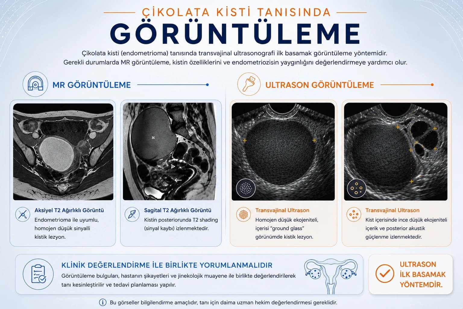 Çikolata kisti tanısında kullanılan MR ve transvajinal ultrason görüntüleme yöntemlerini gösteren medikal infographic görseli.