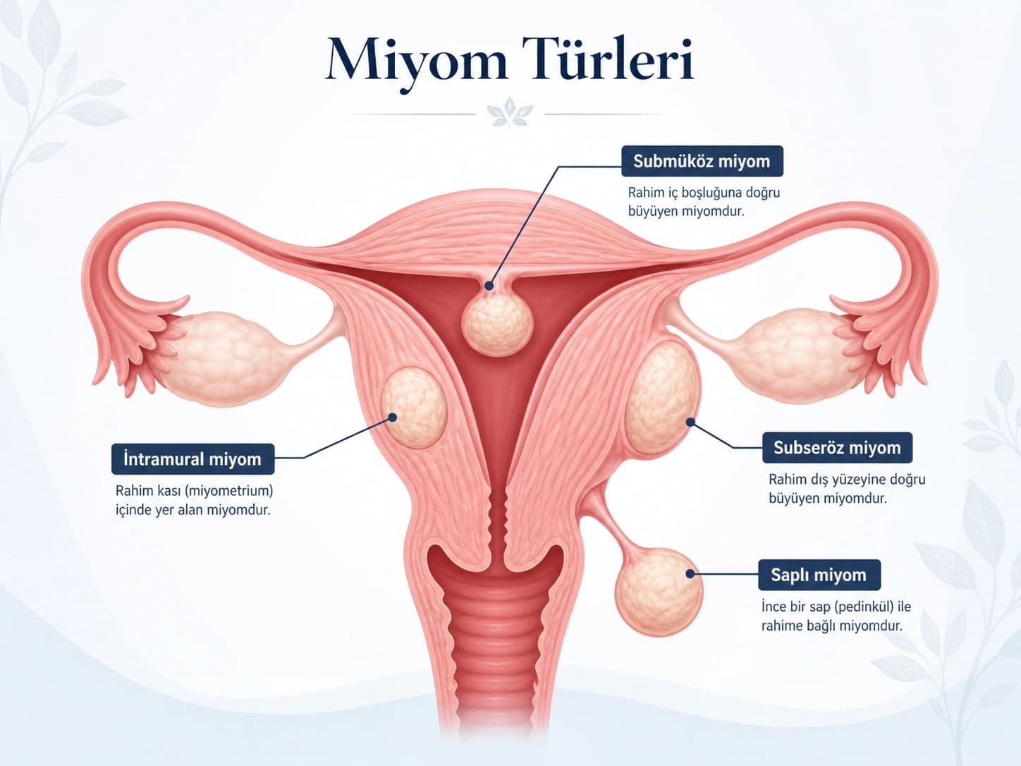 Miyom türlerini gösteren anatomik rahim çizimi; intramural, submüköz, subseröz ve saplı miyomların uterus içindeki yerleşimini gösteren medikal illüstrasyon