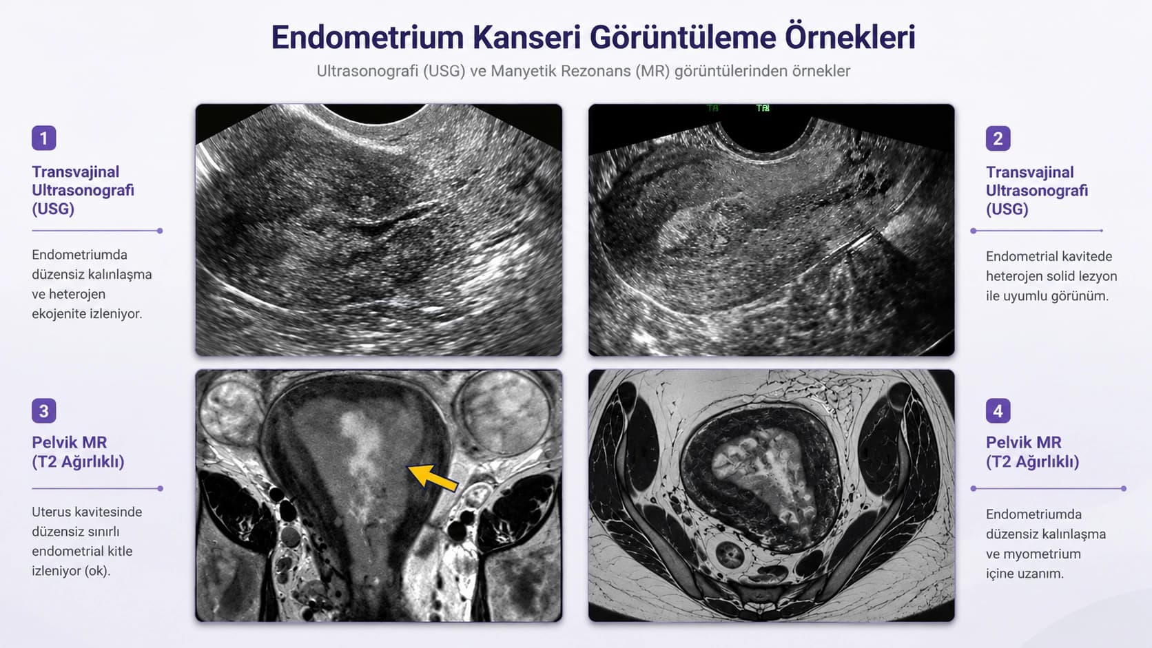Endometrium kanseri tanısında ultrason ve MR görüntüleri