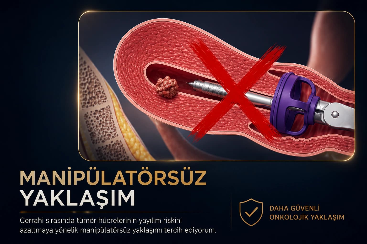 Endometrium kanserinde uterus manipülatörü kullanımına karşı manipülatörsüz cerrahi yaklaşımı ve tümör manipülasyonunu azaltmaya yönelik onkolojik prensipleri gösteren medikal illüstrasyon.
