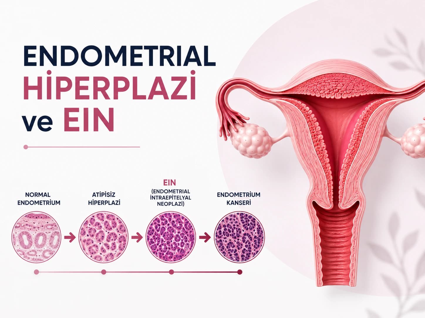 Endometrial Hiperplazi ve EIN Nedir? Rahim Kanseri Riski