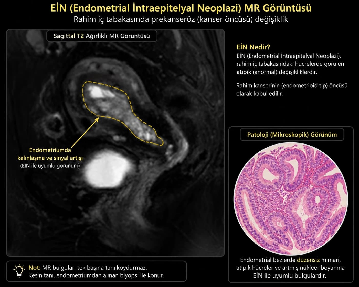 EIN (Endometrial İntraepitelyal Neoplazi) için MR görüntüsü ve mikroskopik patoloji görünümünü karşılaştıran tıbbi infografik