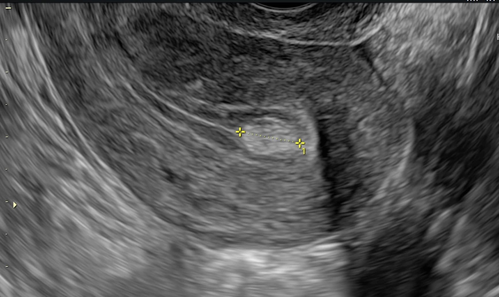 Endometrial polip şüphesi olan hastada transvajinal ultrason ile rahim içi odak lezyonun değerlendirilmesi.