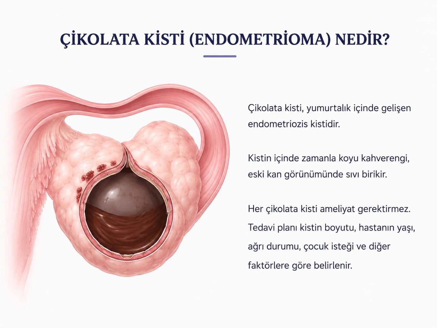 Yumurtalık içinde gelişen çikolata kisti endometrioma anatomik görseli