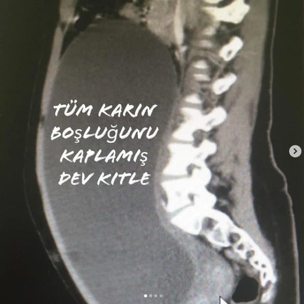 Yumurtalık Kistleri Dev Boyutlara Ulaşabilir