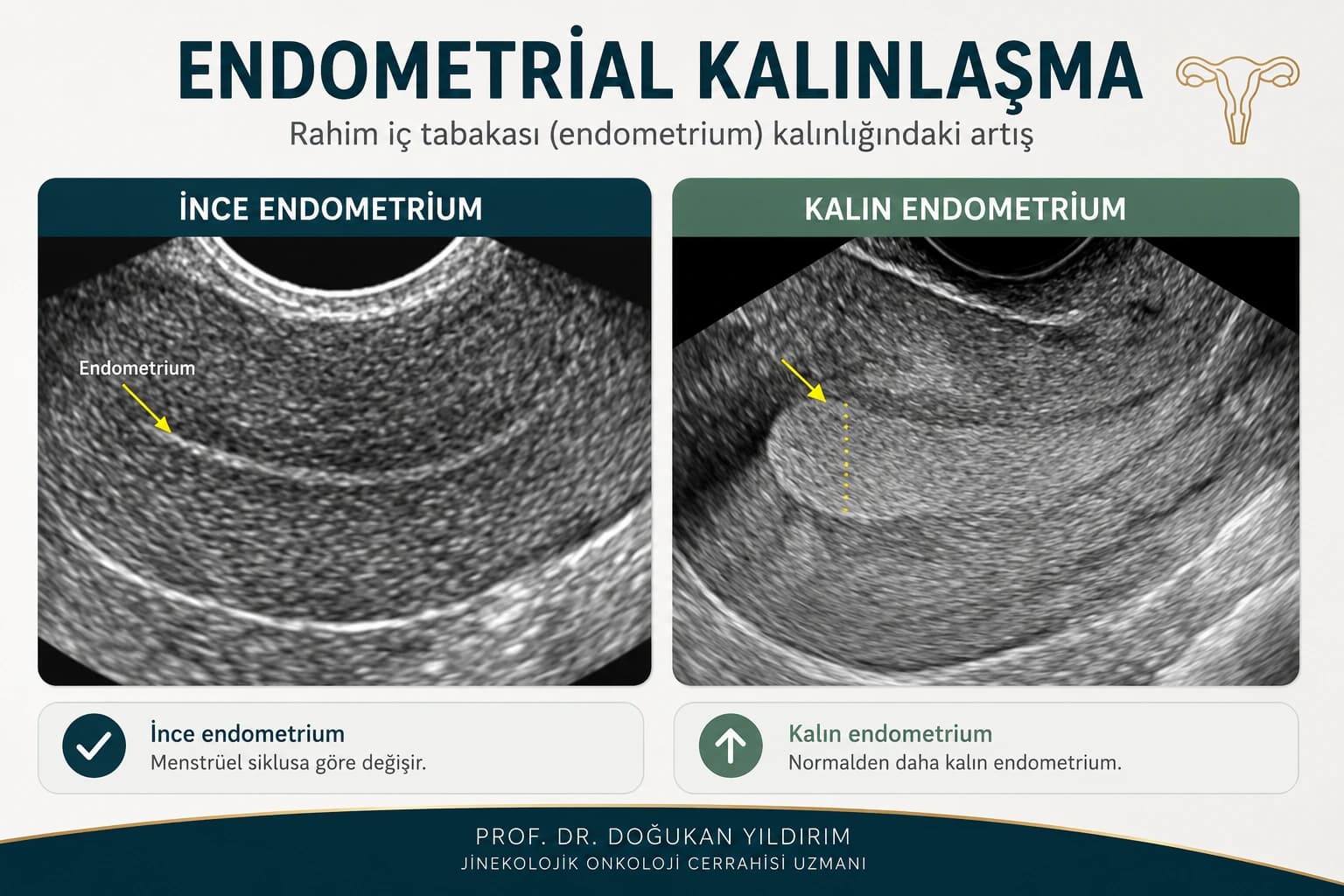 Endometrial kalınlaşma ile normal endometriumun ultrasonografik karşılaştırması