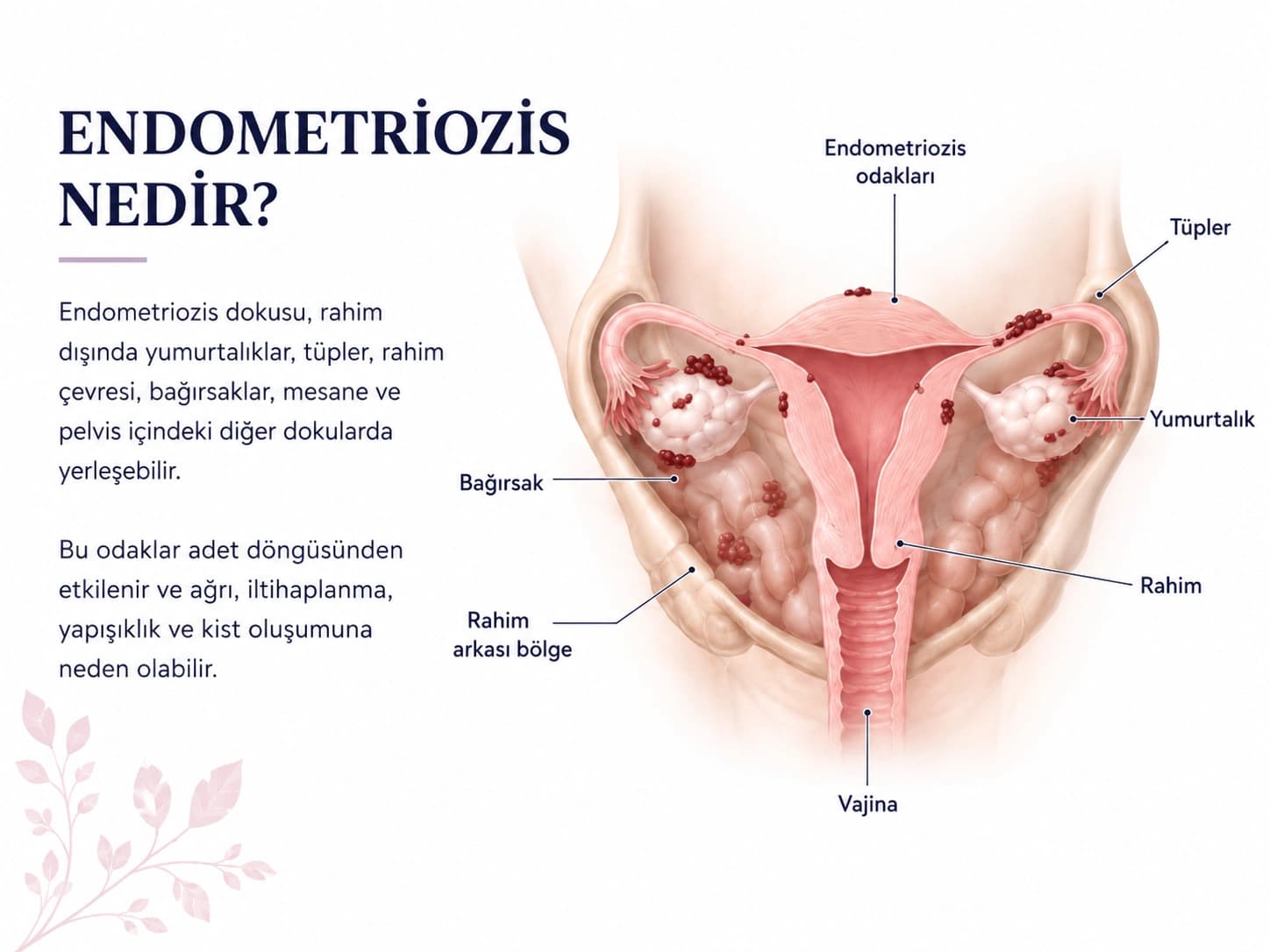 Endometriozis odaklarının pelvis içindeki yerleşimini gösteren anatomik medikal illüstrasyon