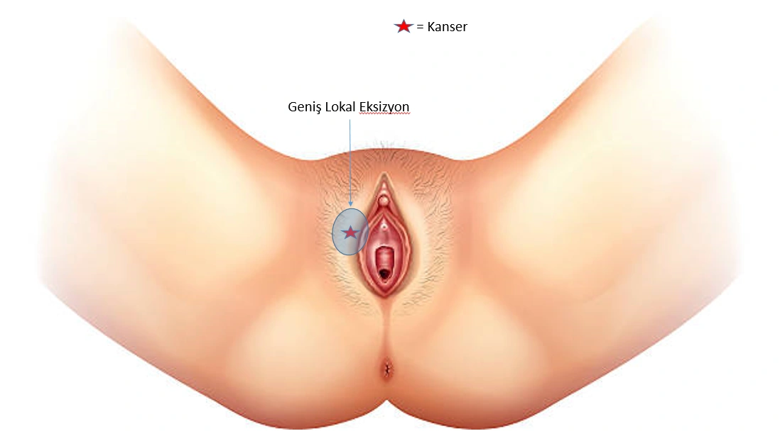 Vulva Kanseri